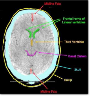 Flashcards - Neurosurgery Radiology