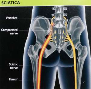 Flashcards - Everyday Sports Injuries