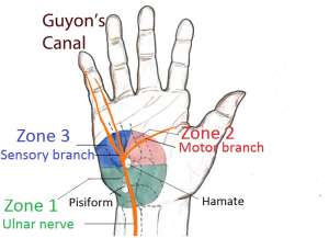 Guyon-Canal-Zones-1