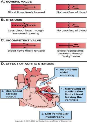 Flashcards - Patho Heart