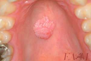 OralPapilloma1