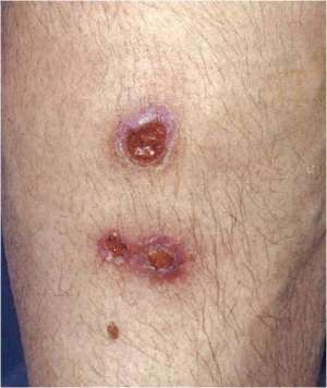 Flashcards - Derm infections Pictures Pt 1