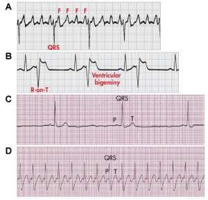 A Nurse is Caring for a Client How is to Receive Continuous Iv Oxytocin