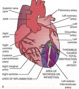 Flashcards - Patho Heart