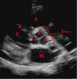 Flashcards - Echo1 Parasternals Anatomy