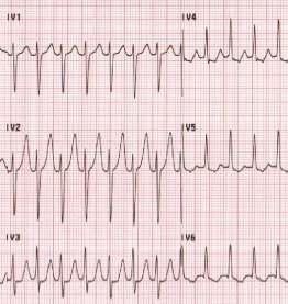 Flashcards - EKG T5 och T6 Huddinge, del 2 (av 2)