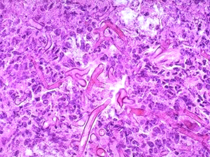mucormycosis1353873809113